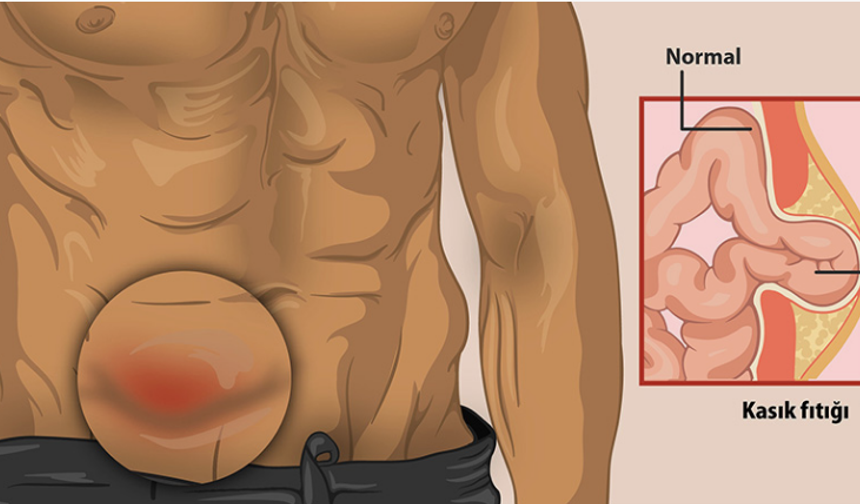 Kasık fıtığı belirtileri ve tedavisi nedir?